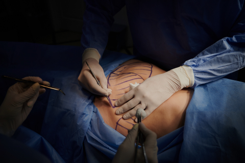 Augmentation Mammoplasty